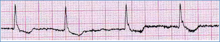arrhythmias: Atrial Fibrillation