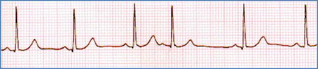ATRIAL PREMATURE BEATS
