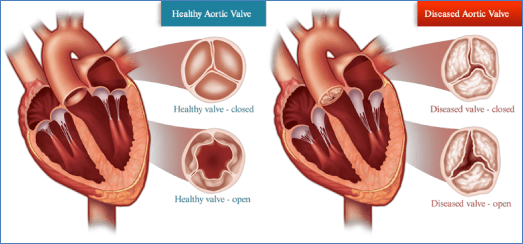 Aortic Stenosis - Valvular Heart Disease