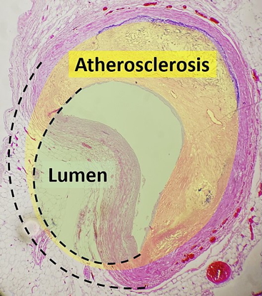 Atherosclerosis in ischaemic heart disease