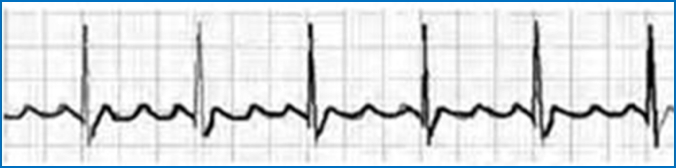 Atrial Flutter