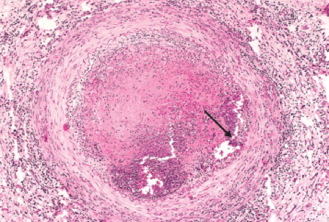 BUERGER’S DISEASE - Vasculitides