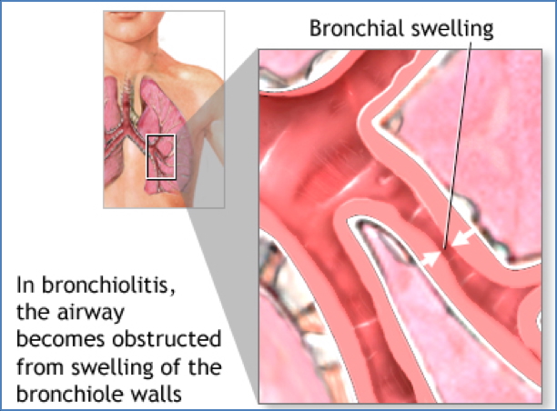Bronchiolitis
