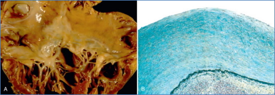 Carcinoid heart disease