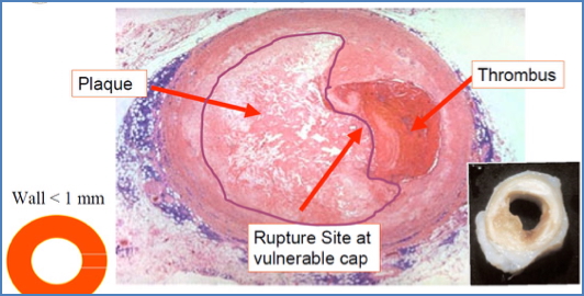 Complicated plaque in atherosclerosis