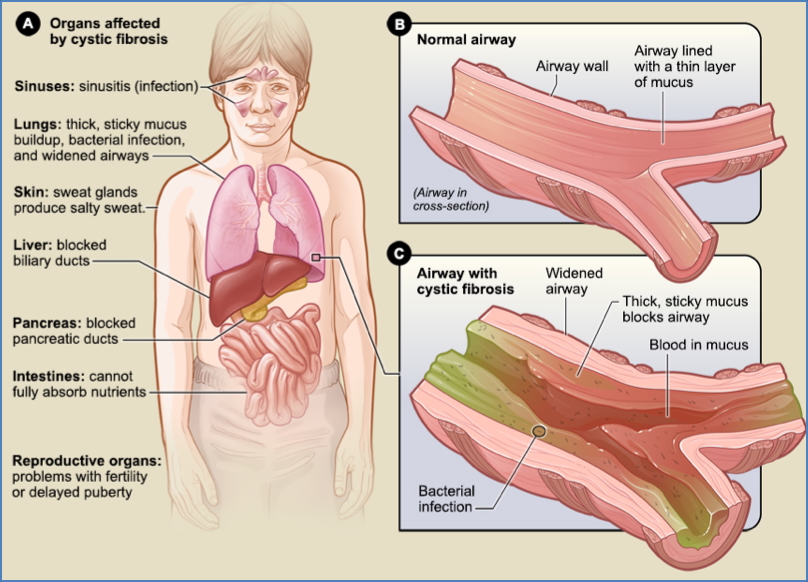 Cystic Fibrosis - organs affected