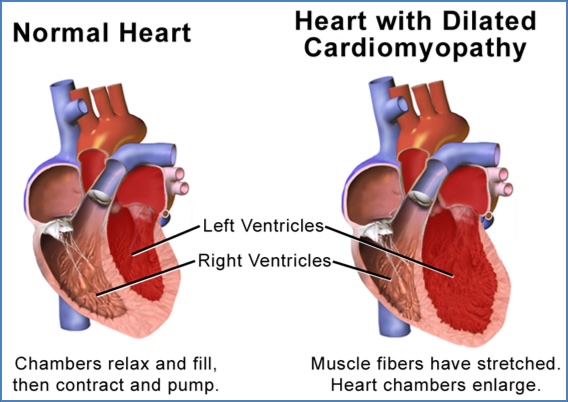 Dilated Cardiomyopathy