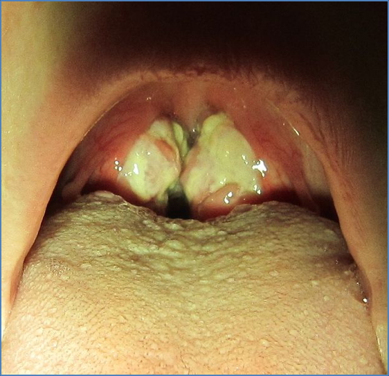 infectious mononucleosis EBV pharyngitis