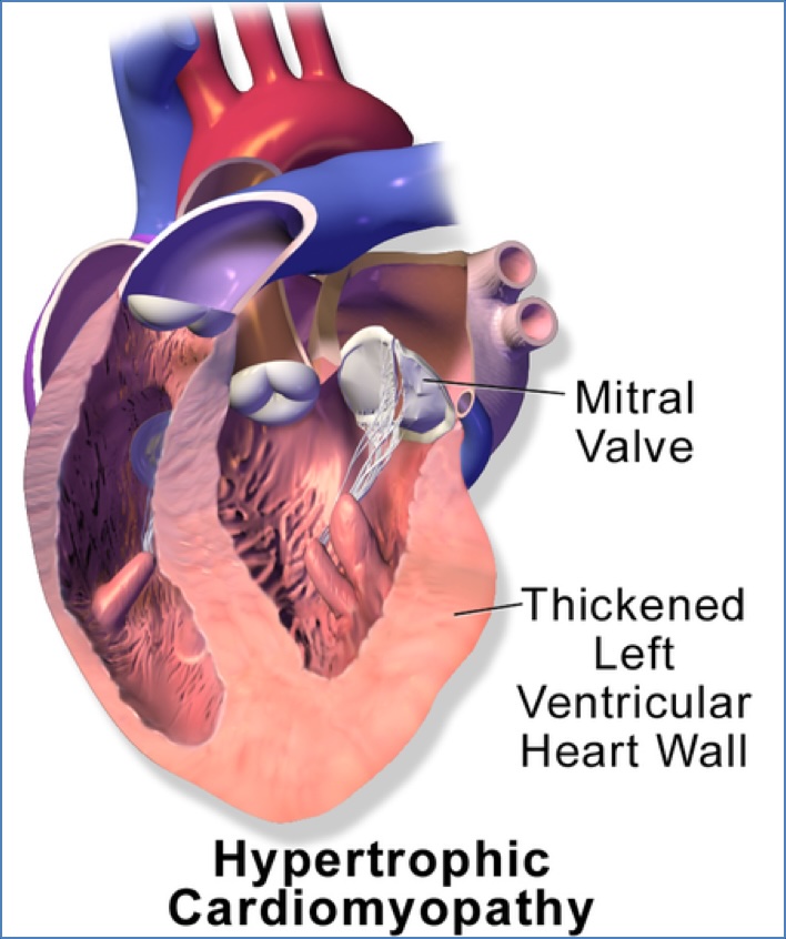 HOCM - Hypertrophic Obstructive Cardiomyopathy