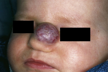 vascular tumours: Haemangioma (Nose)
