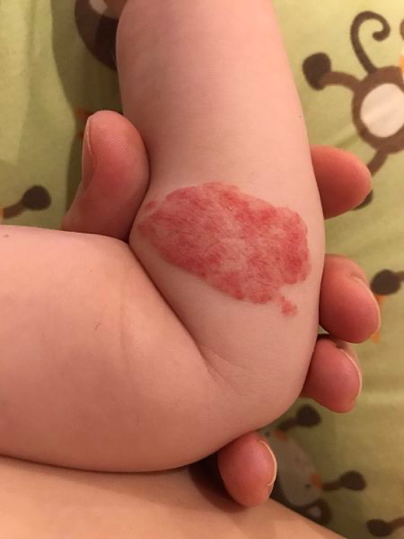 vascular tumours: Haemangioma (Arm)