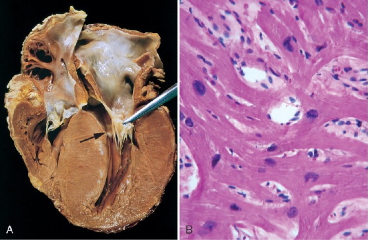 Hypertrophic Cardiomyopathy Cross section & pathology slide