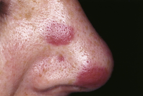Kaposi Sarcoma (Nose)