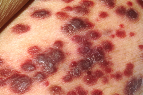 Kaposi Sarcoma (Skin)