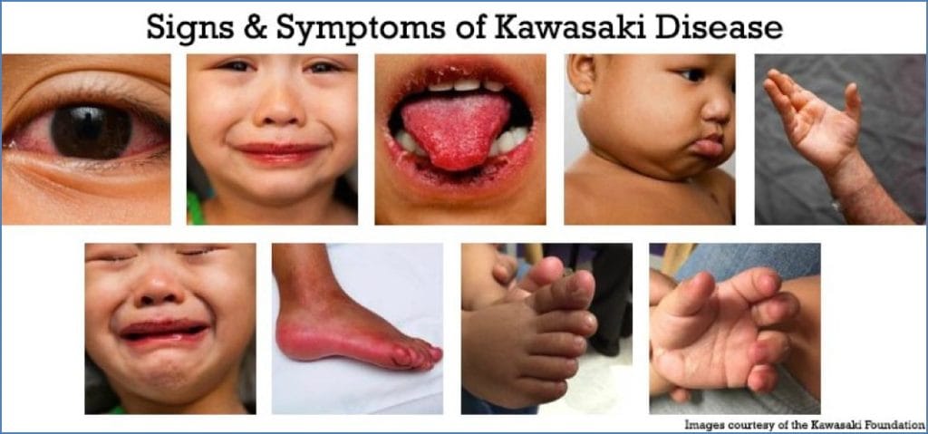 Kawasaki Disease - Vasculitides