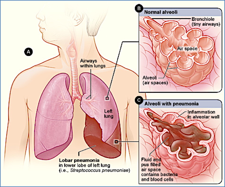 Lobar Pneumonias