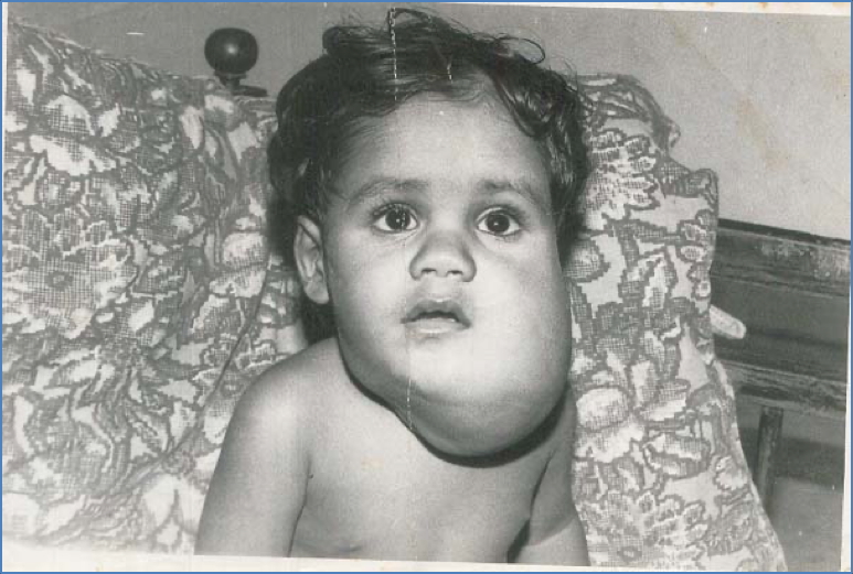 vascular tumours: Lymphangioma