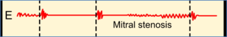 Mitral stenosis - murmur