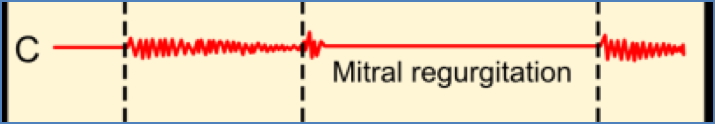 Mitral Regurgitation Murmur phonogram