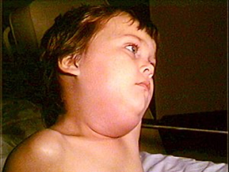 Mumps parotitis