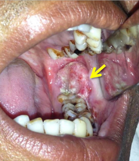 Oral Squamous Cell Carcinoma