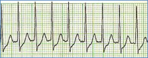 Paroxysmal Supraventricular Tachycardia (PSVT)