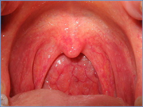 Viral Pharyngitis