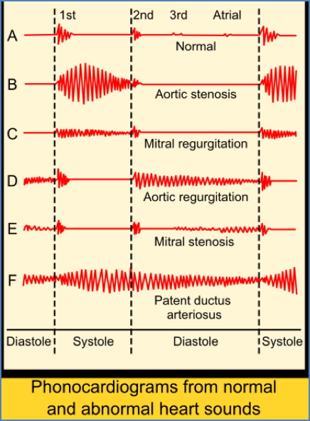 Phonocardiograms - Valvular heart disease & murmurs