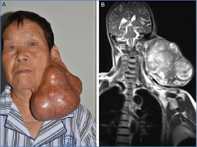 Salivary Gland Tumours - PLEOMORPHIC ADENOMA 