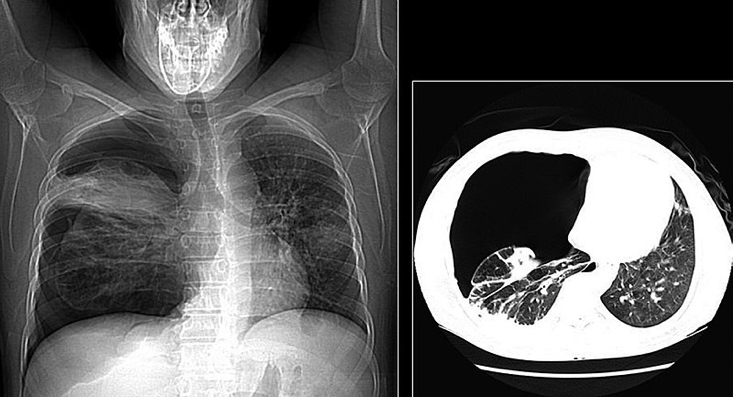 pneumothorax CXR & CT