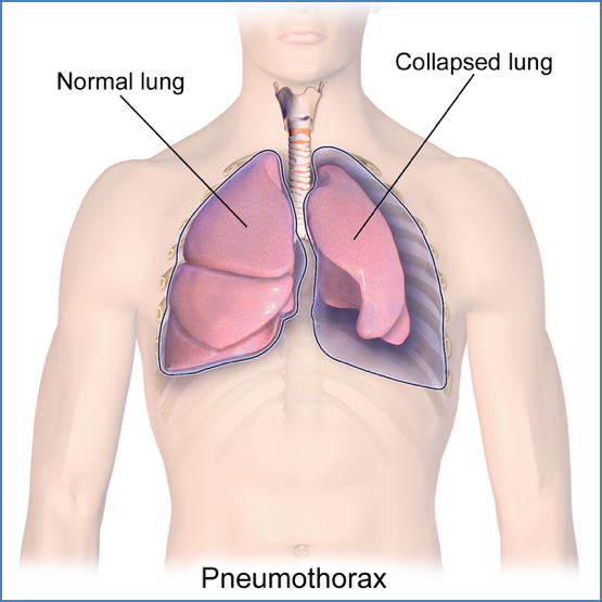 Pneumothorax vs normal lung