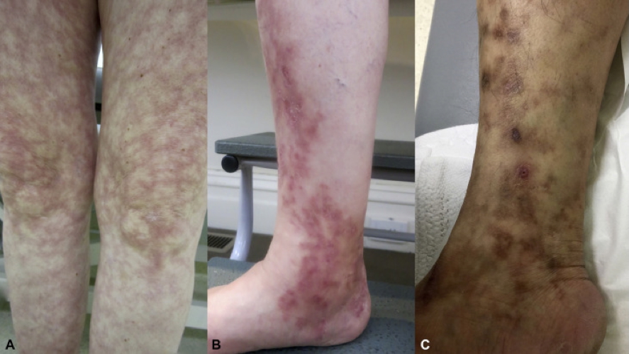 Polyarteritis Nodosa (PAN) - medium vessel vasculitides