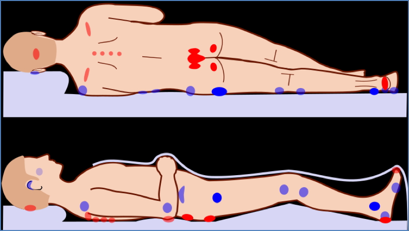 Common locations of pressure ulcers
