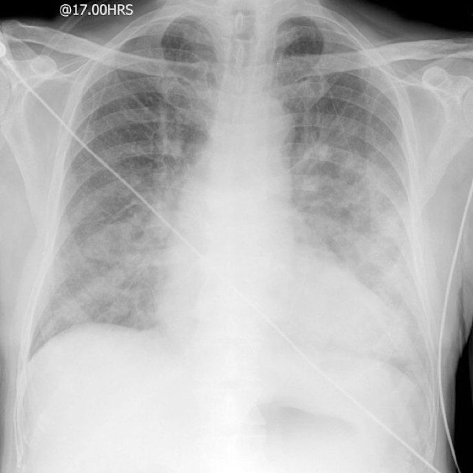 Pulmonary Oedema