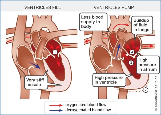 Restrictive Cardiomyopathy