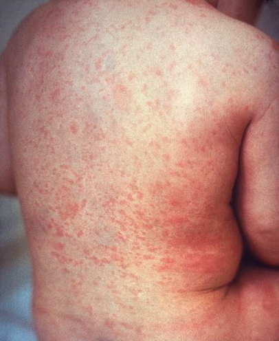 Rubella rash