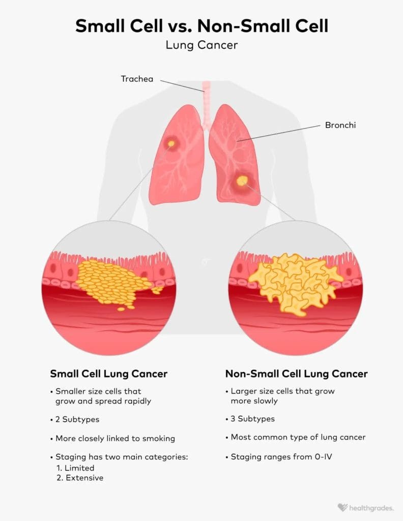 Lung cancer - SCLC vs NSCLC