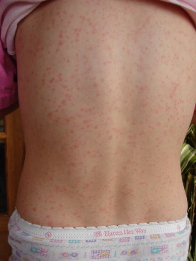 Scarlet Fever - rash