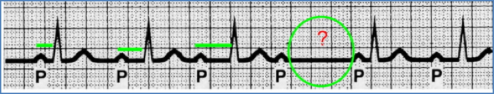 MOBITZ TYPE-I (WENCKEBACH) Second-Degree Heart Block