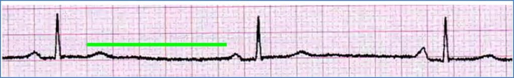 arrhythmias: Sinus Bradycardia