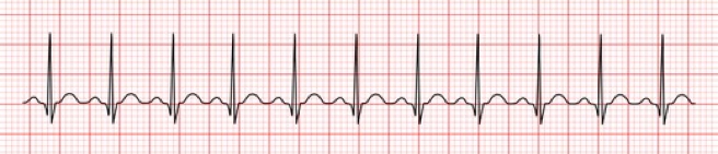 arrhythmias: Sinus Tachycardia