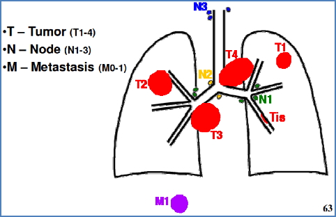 TNM Lung Cancer staging