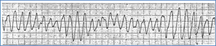 arrhythmias: Torsades De Pointes “Twisting Of The Points”