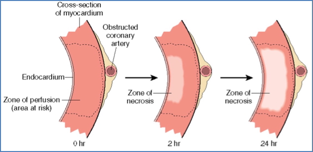 ischaemic heart disease Progression