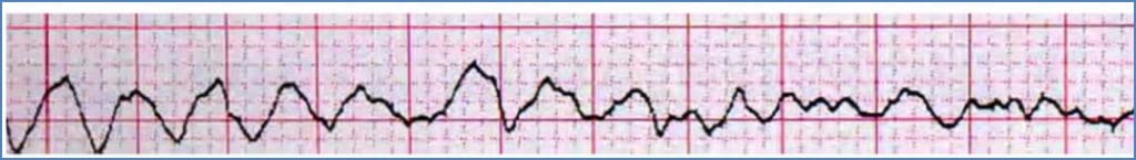 arrhythmias: Ventricular Fibrillation