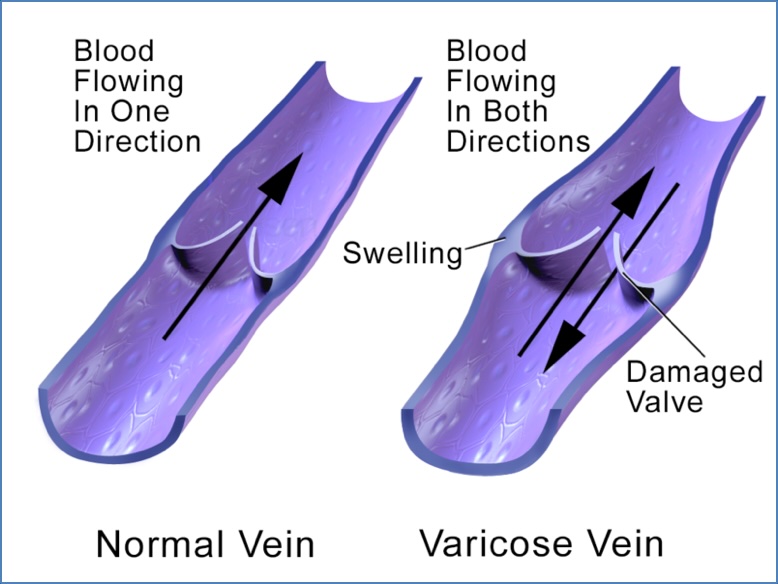 Varicose Veins Incompetent valves