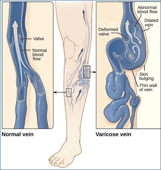 Varicose Veins Diagram