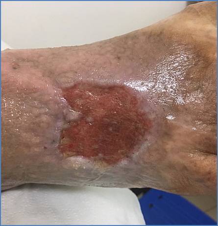 Venous Chronic Ulcer