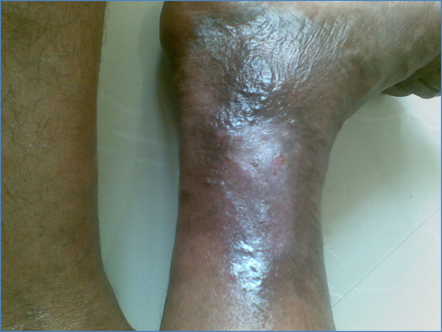 Chronic Venous Ulcer