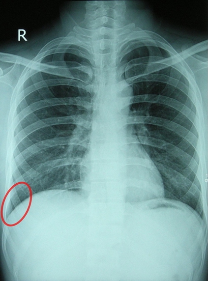 Diaphragmatic Recess Xray